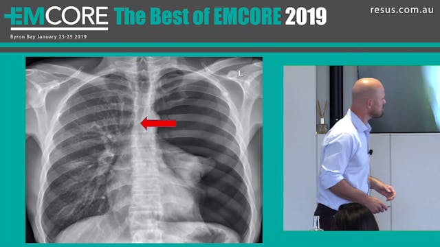 Tension Pneumothorax Gerben Keijzers