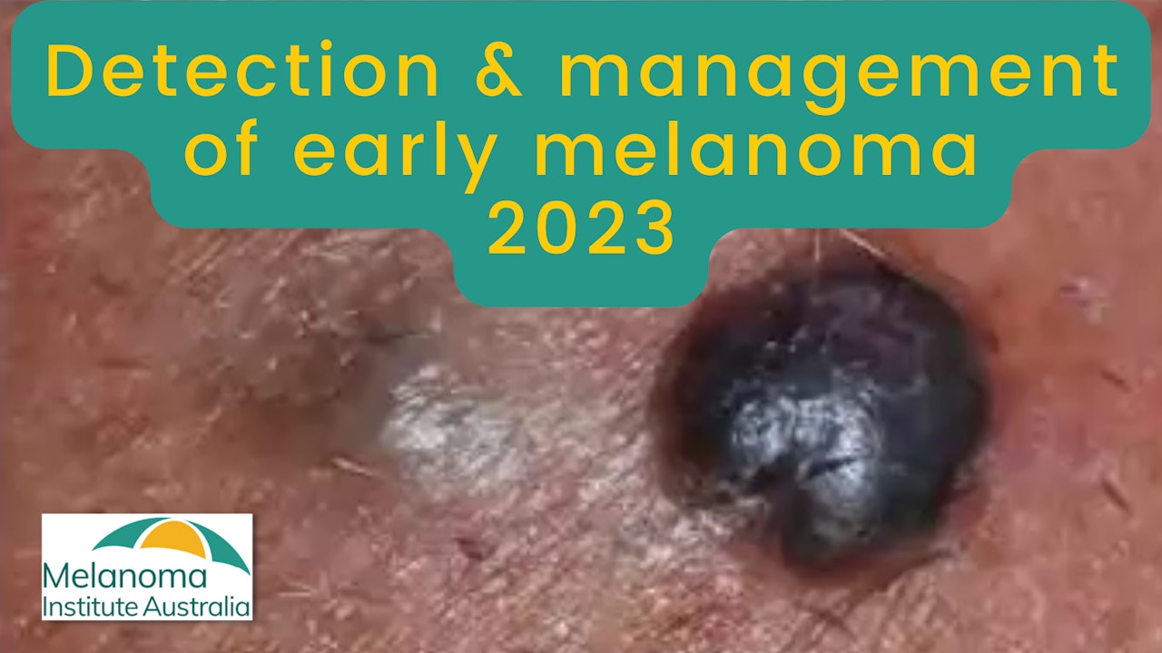 Detection & management of early melanoma in 2023