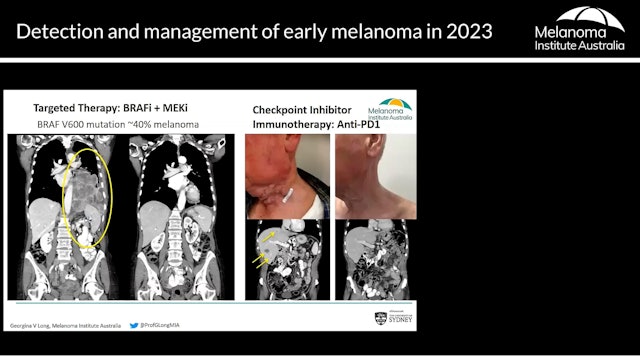 The increasing role of systemic therapy in early melanoma – Prof Georgina Long AO (Medical Oncologist)