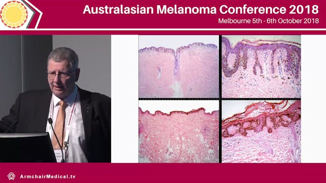 Dermoscopic Subtypes of benign naevi ...