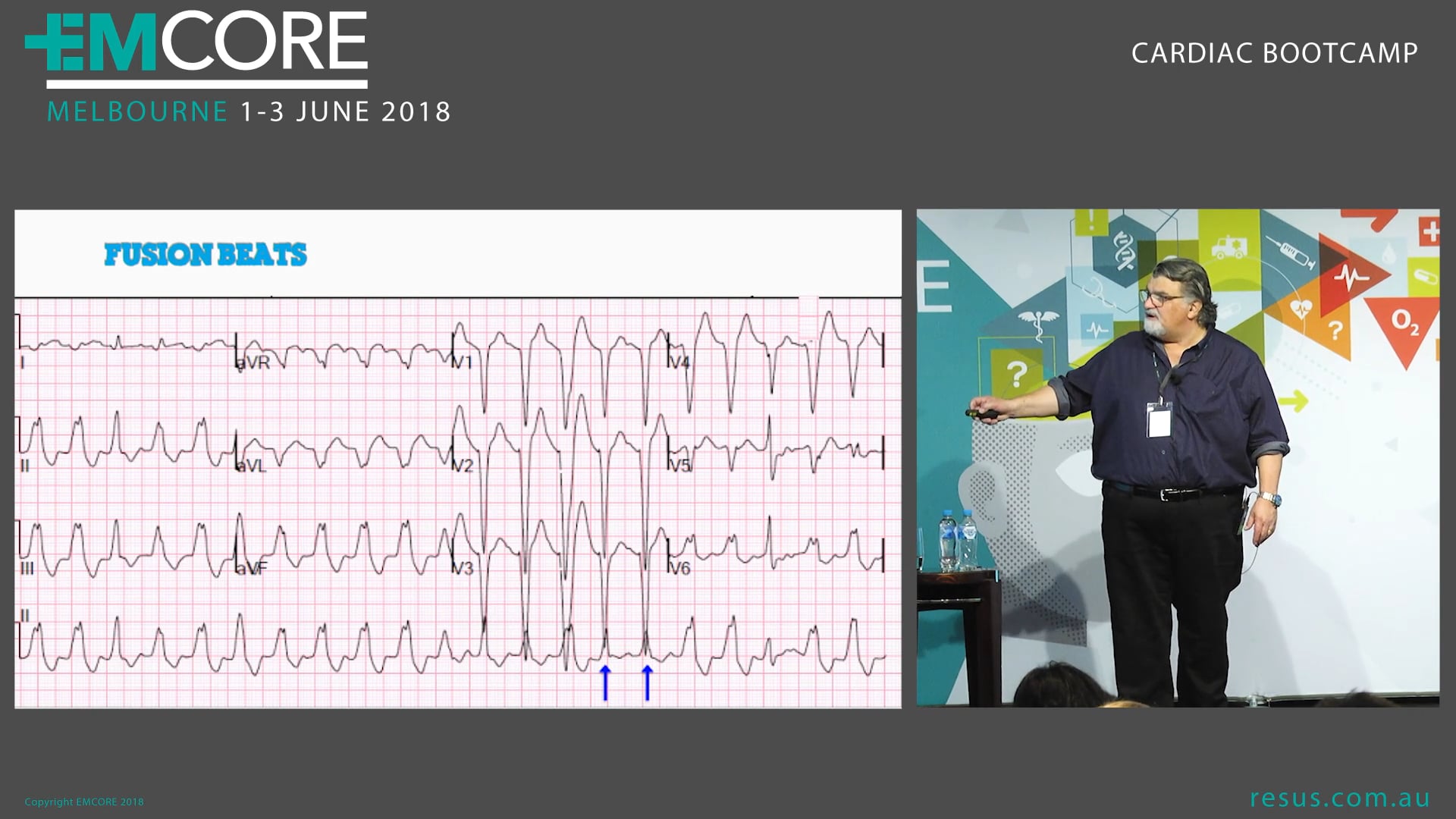 Diagnosing the wide complex rhythm Assoc Prof Peter Kas