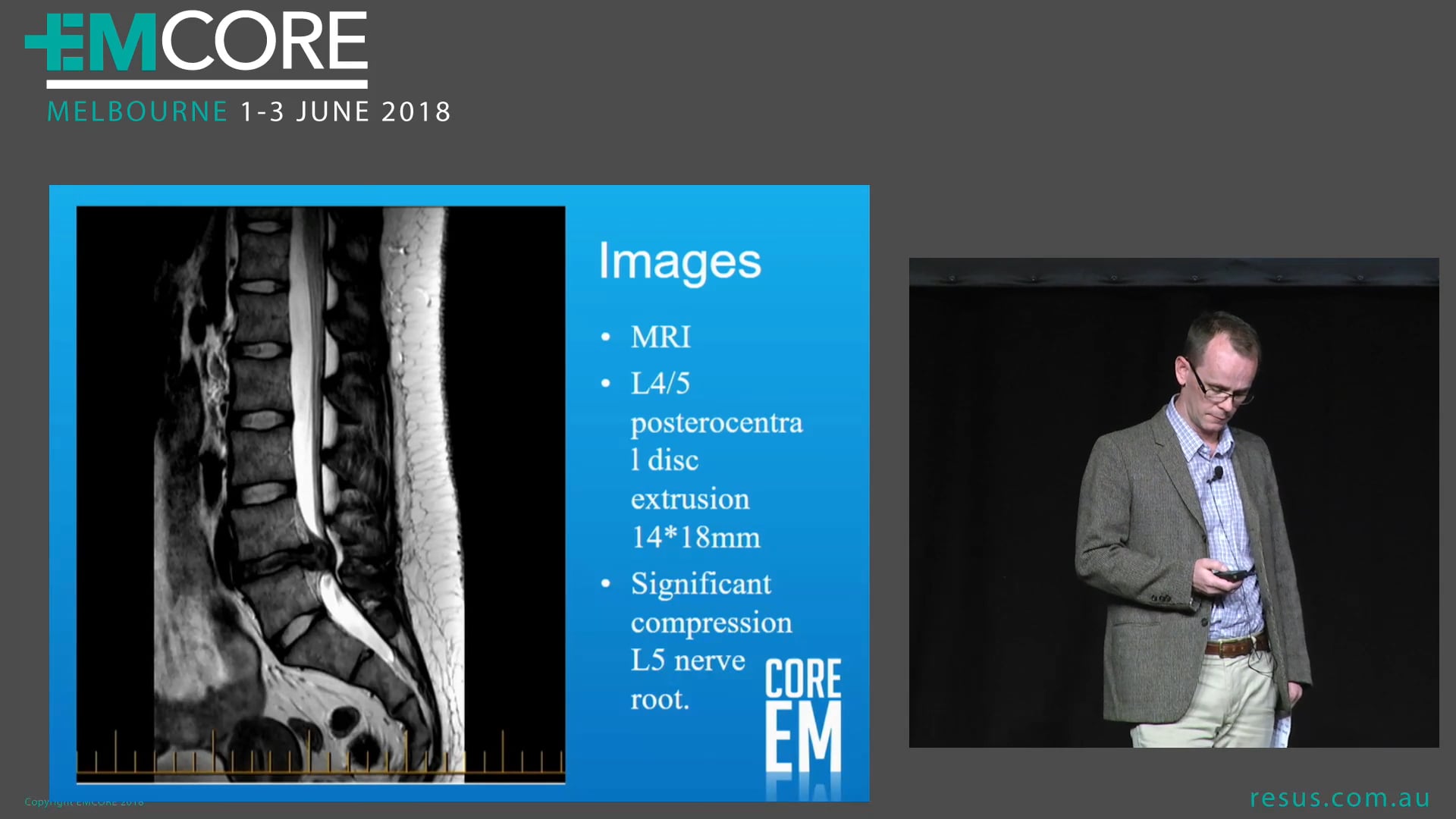 Cauda equina Dr Jaycen Cruickshank