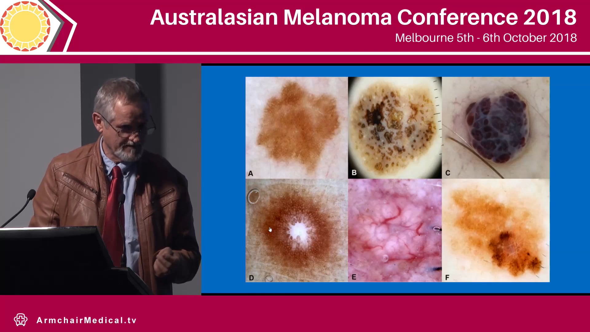 An approach to dermoscopy in clinical practice Cliff Rosendahl