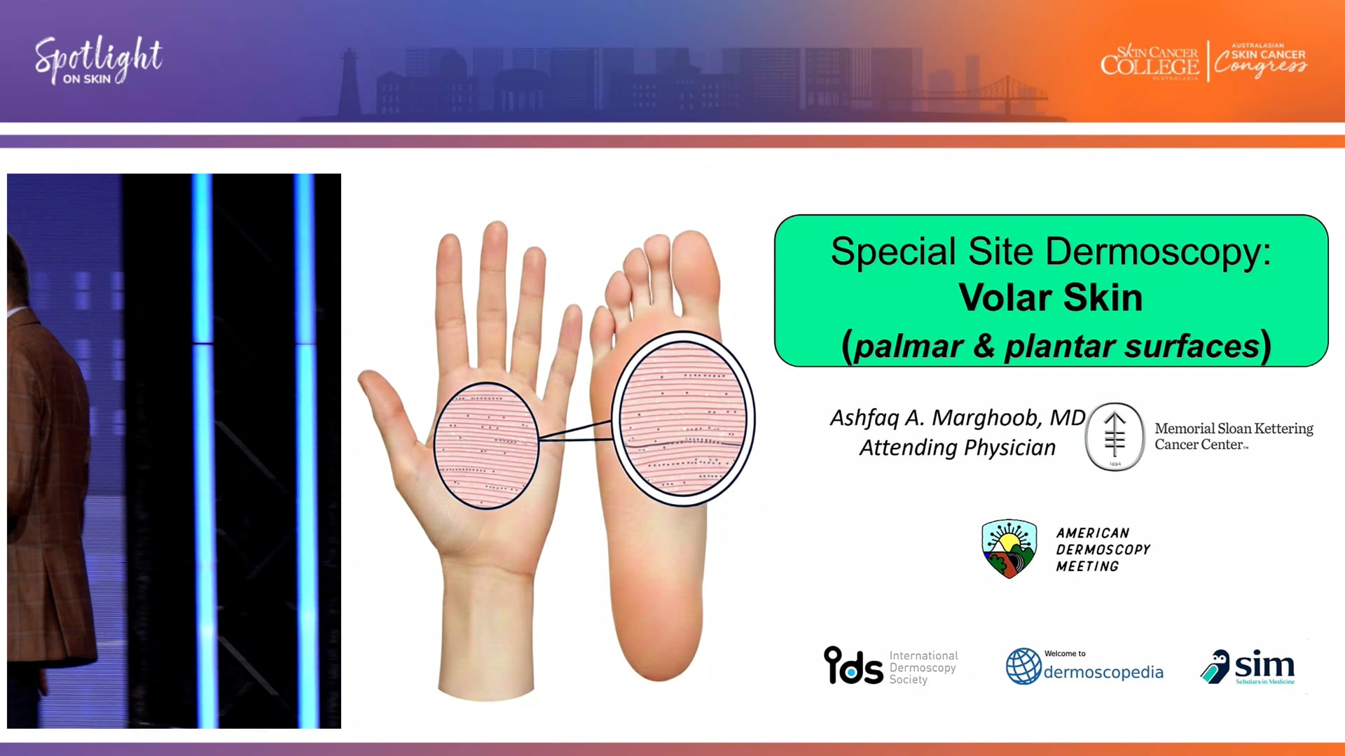 Dermoscopy Masterclass Volar Surfaces Dr Ashfaq Marghoob