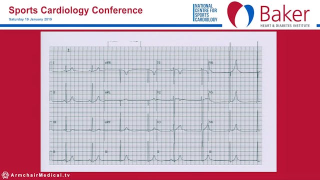 Athlete ECG Quiz Maria Brosnan