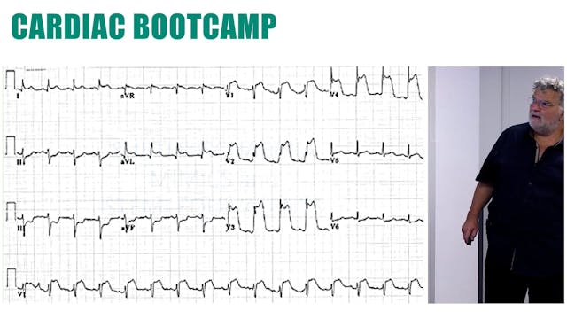 Ischaemia, mimics, sneaky ischaemia, ...