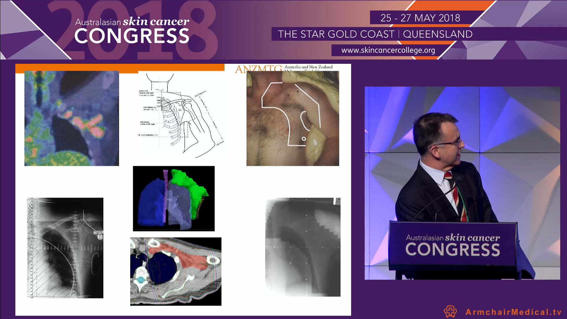 Update on the role of radiotherapy in melanoma Prof Gerald Fogarty