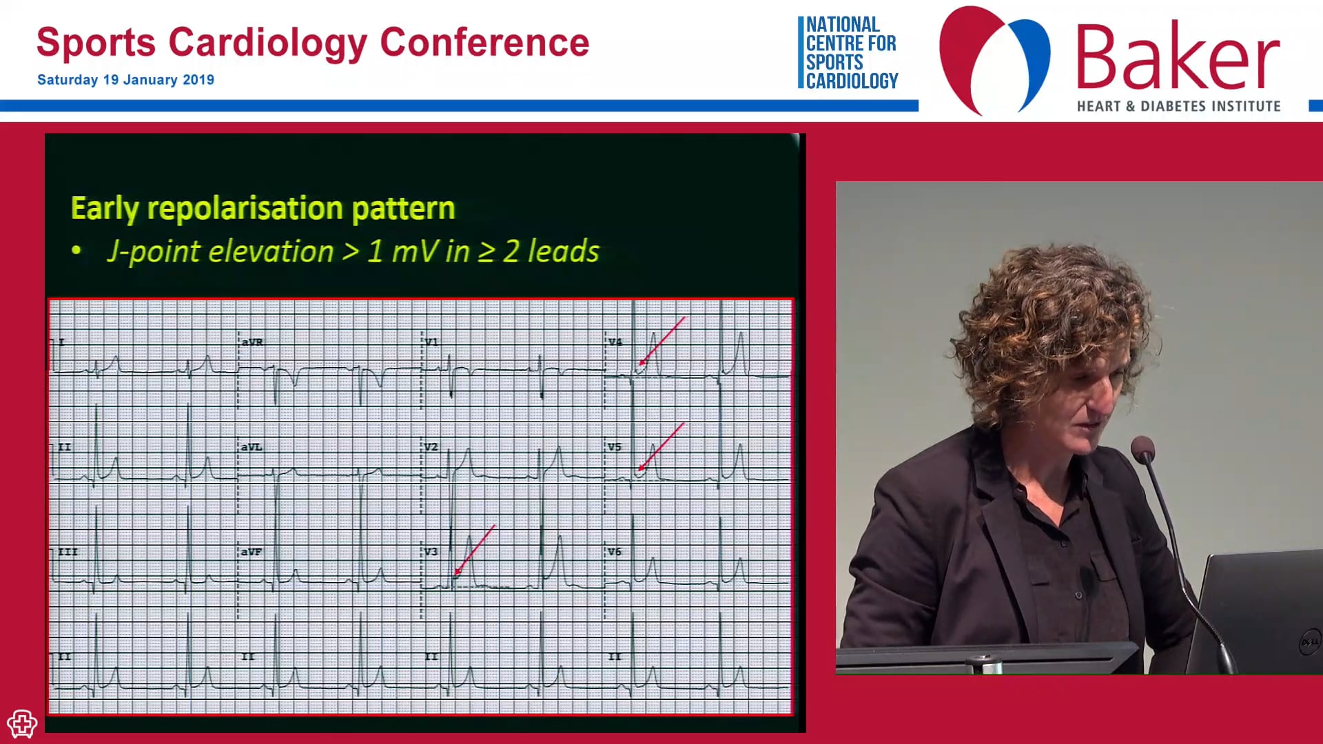 Athlete ECG interpretation Maria Brosnan