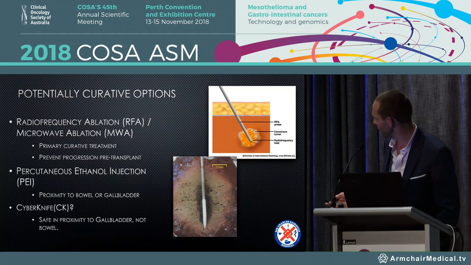 State of the Art and Emerging Interventional Radiology Hepatocellular Cancer management. - Shaun Samuelson