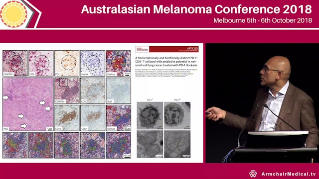 Turning cold tumours hot with intralesional therapy in melanoma Adil Daud