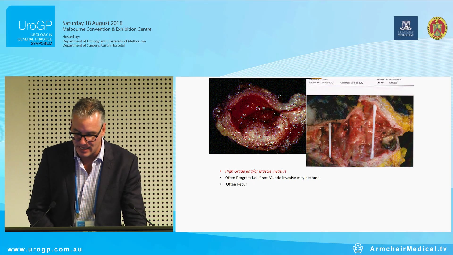 Bladder Cancer and the GP involvement Assoc. Prof Nathan Lawrentschuk