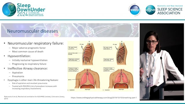 Sleep disordered breathing in neuromu...