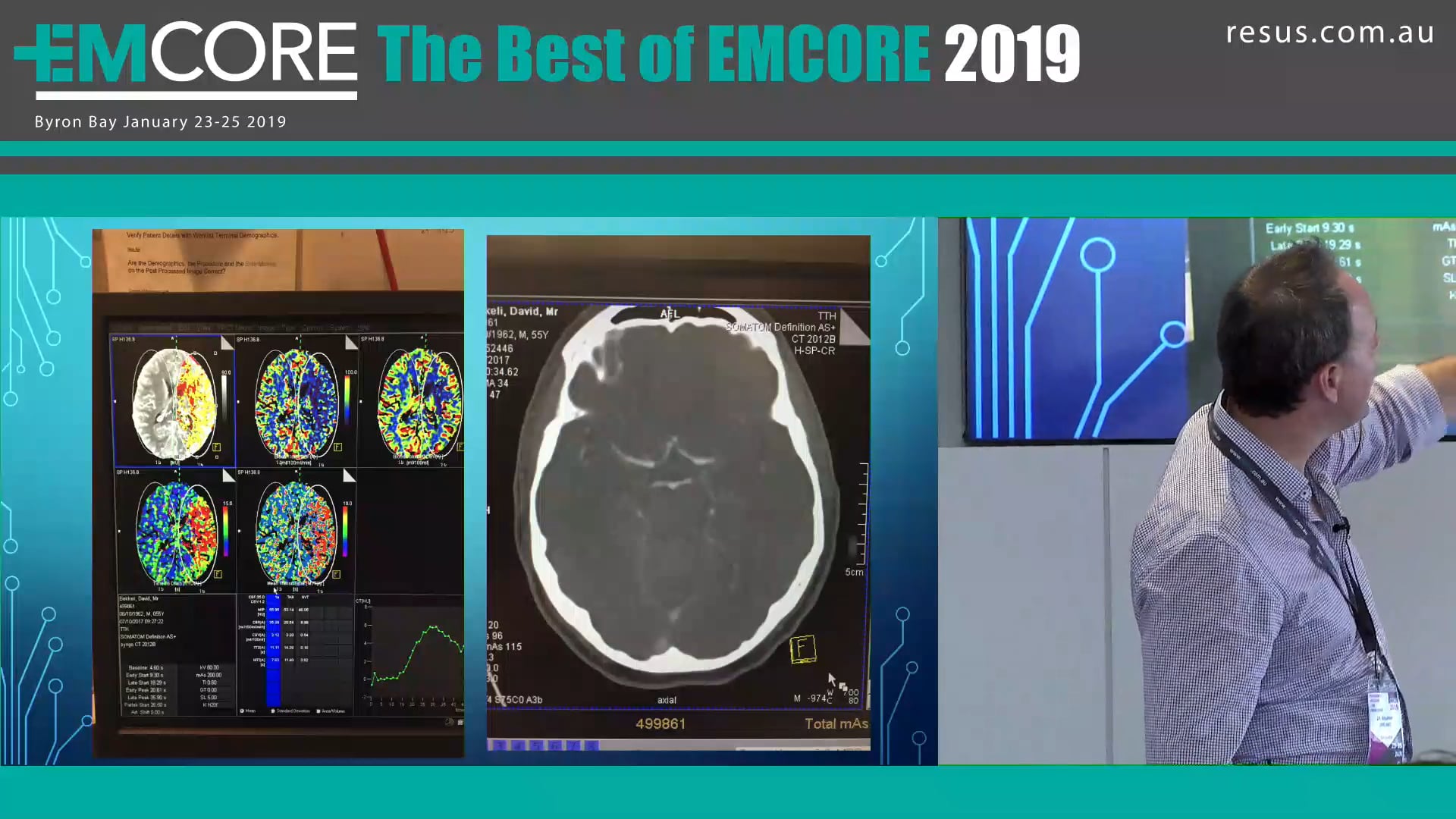 Large vessel Occlusion Stroke Who should we call Graham Ireland