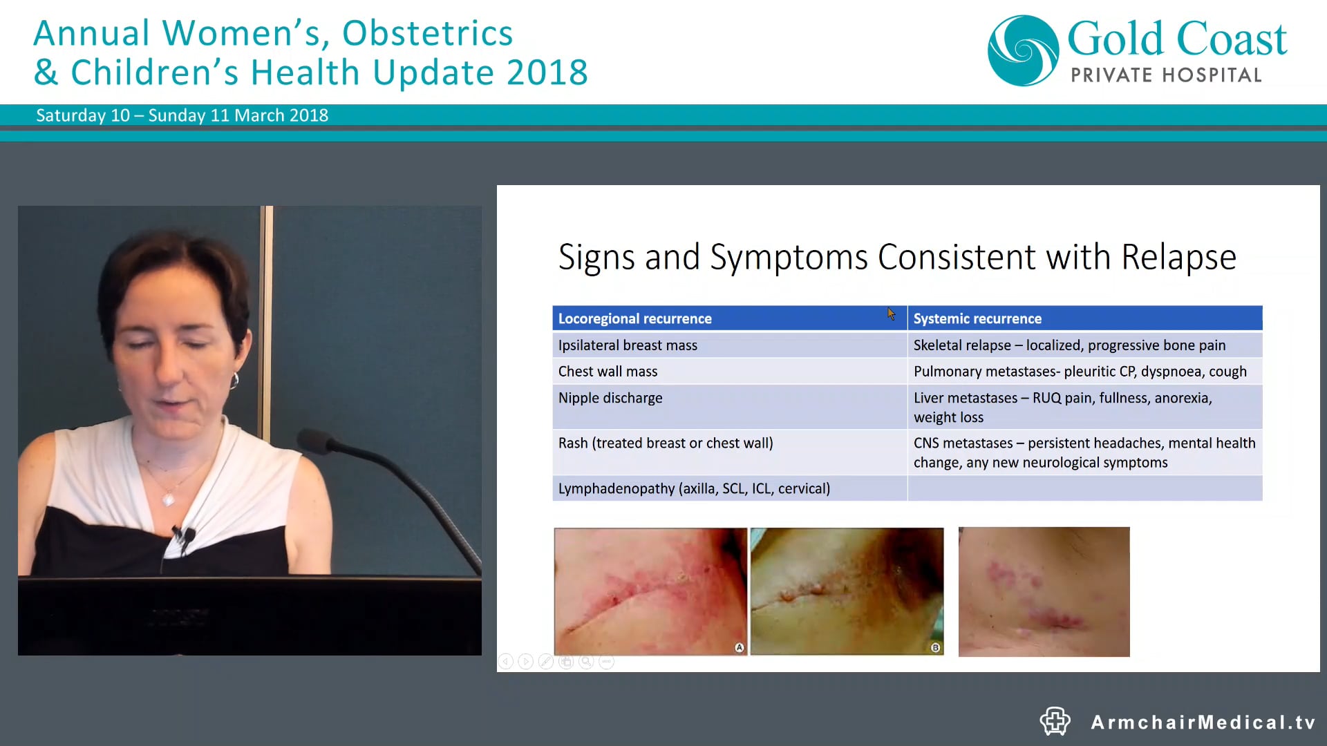 Life after Breast Cancer Dr Andrea Tazbirkova, Oncologist