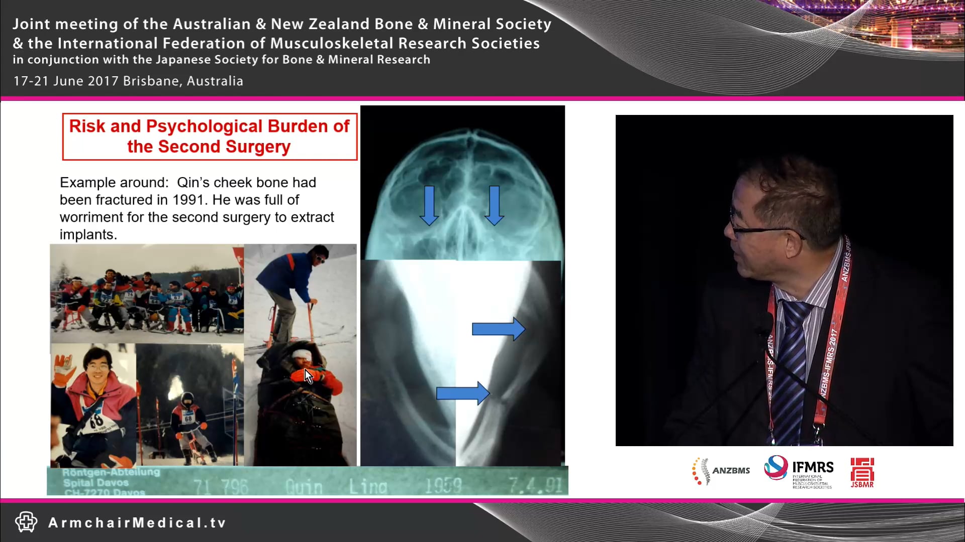 Mg-based biometal and hybrid fixation device as innovative concept to promote fracture healing Prof Ling Qin