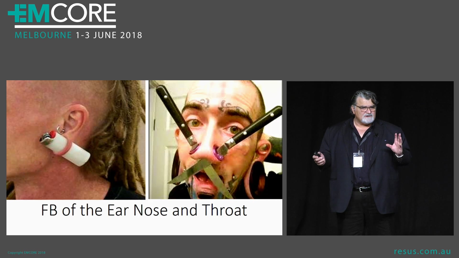 Foreigh body of Ear Nose and throat Assoc Prof Peter Kas