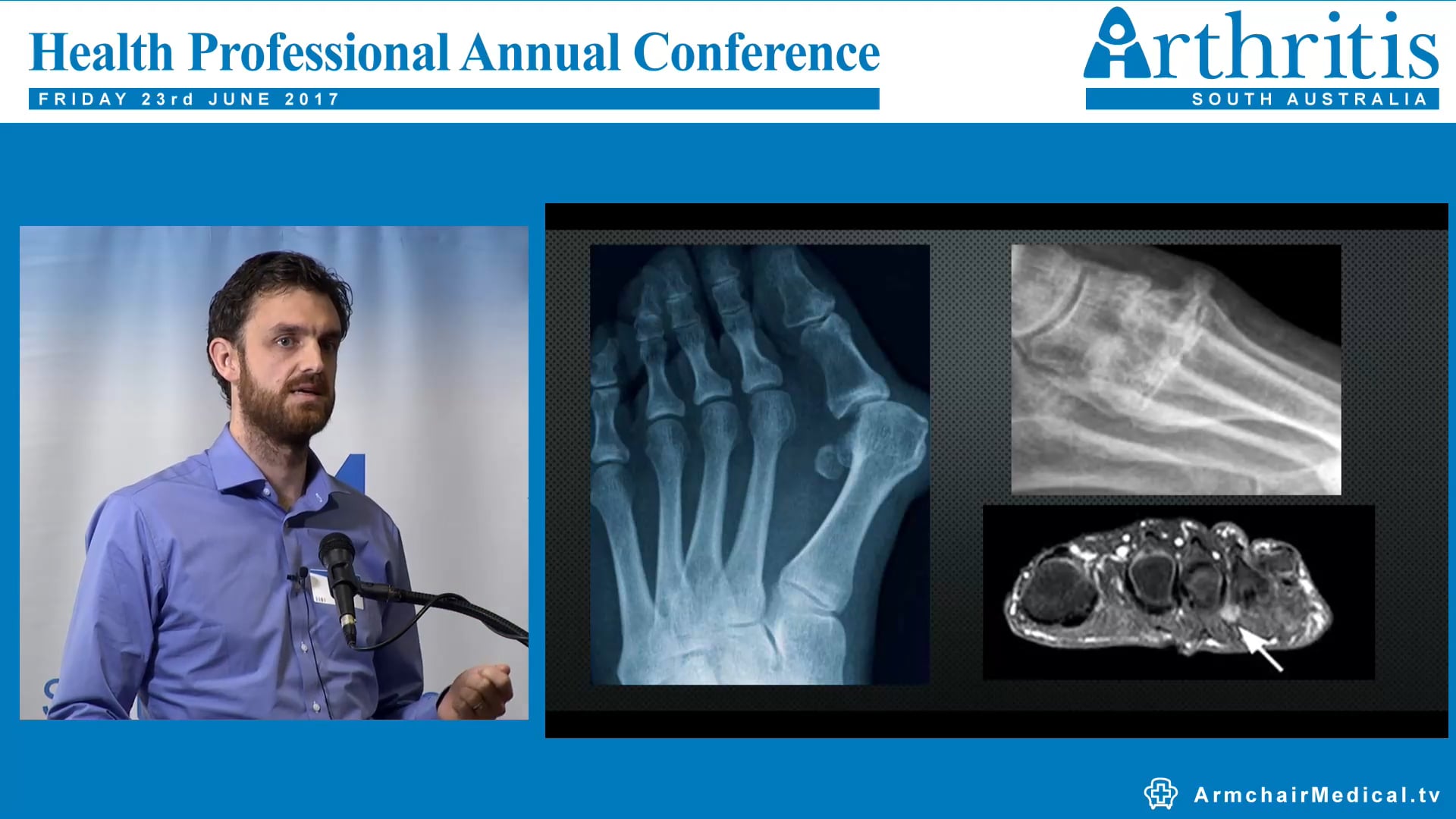 Obesity and Musculoskeletal foot pain - the underlying mechanisms Tom Walsh Podiatrist