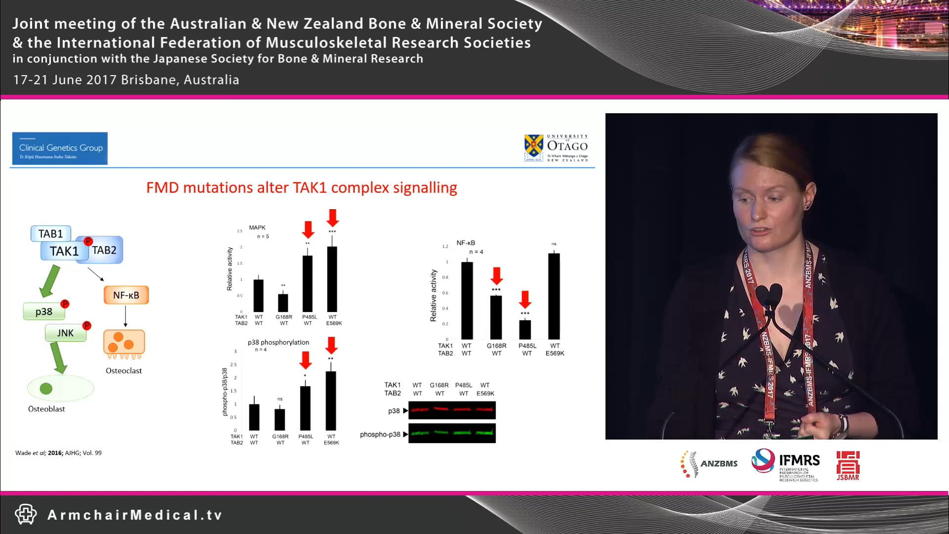 OA Mutations in MAP3K7 and TAB2 cause autosomal dominant frontometaphyseal dysplasia Emma Wade