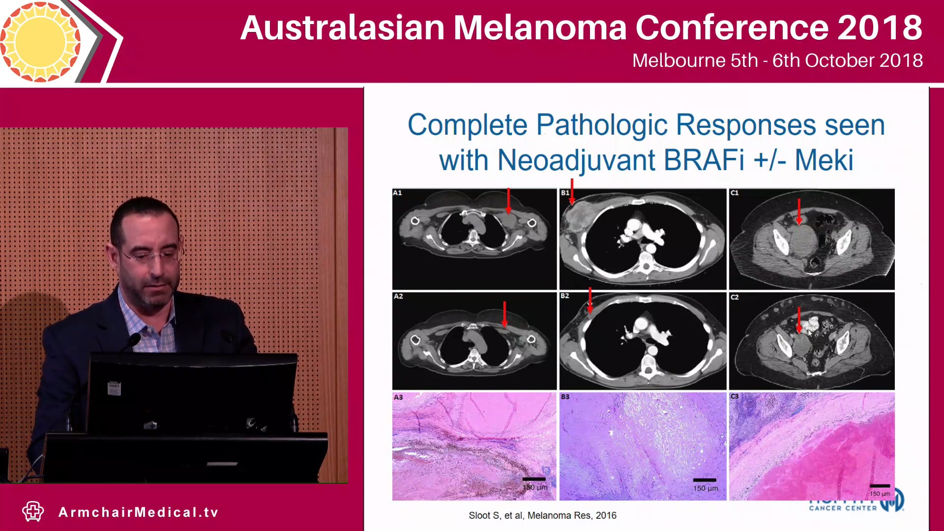 Debate Surgery is the optimal management for oligo metastatic disease Jonathan Zager