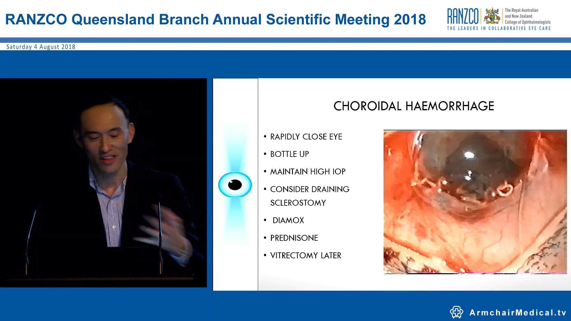 Challenges in managing cataract surgery complications Lawrence Lee
