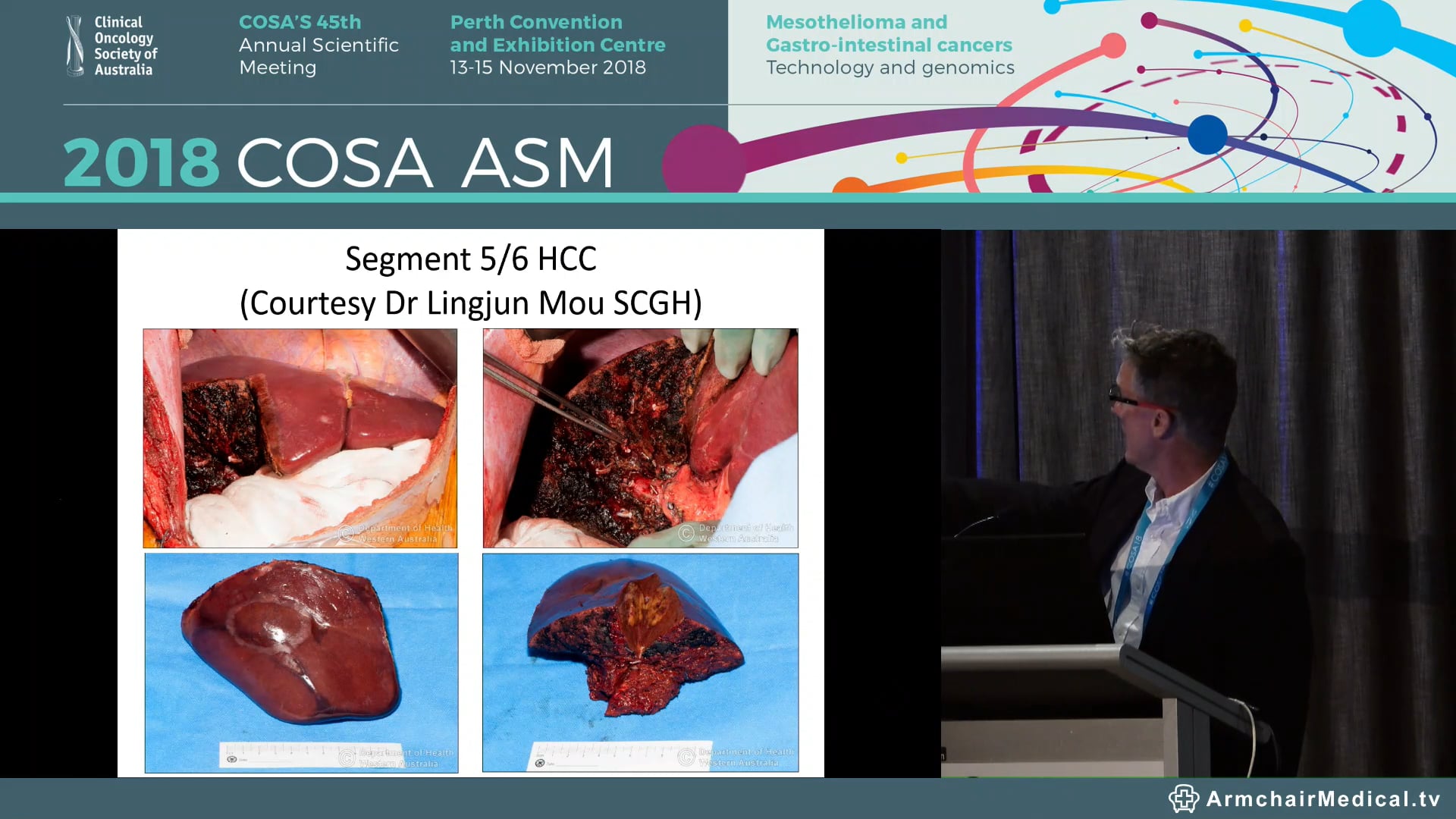 Surgical Options for the management of Hepatocellular Cancer in Patients with Chronic Liver Disease - Bryon Jaques