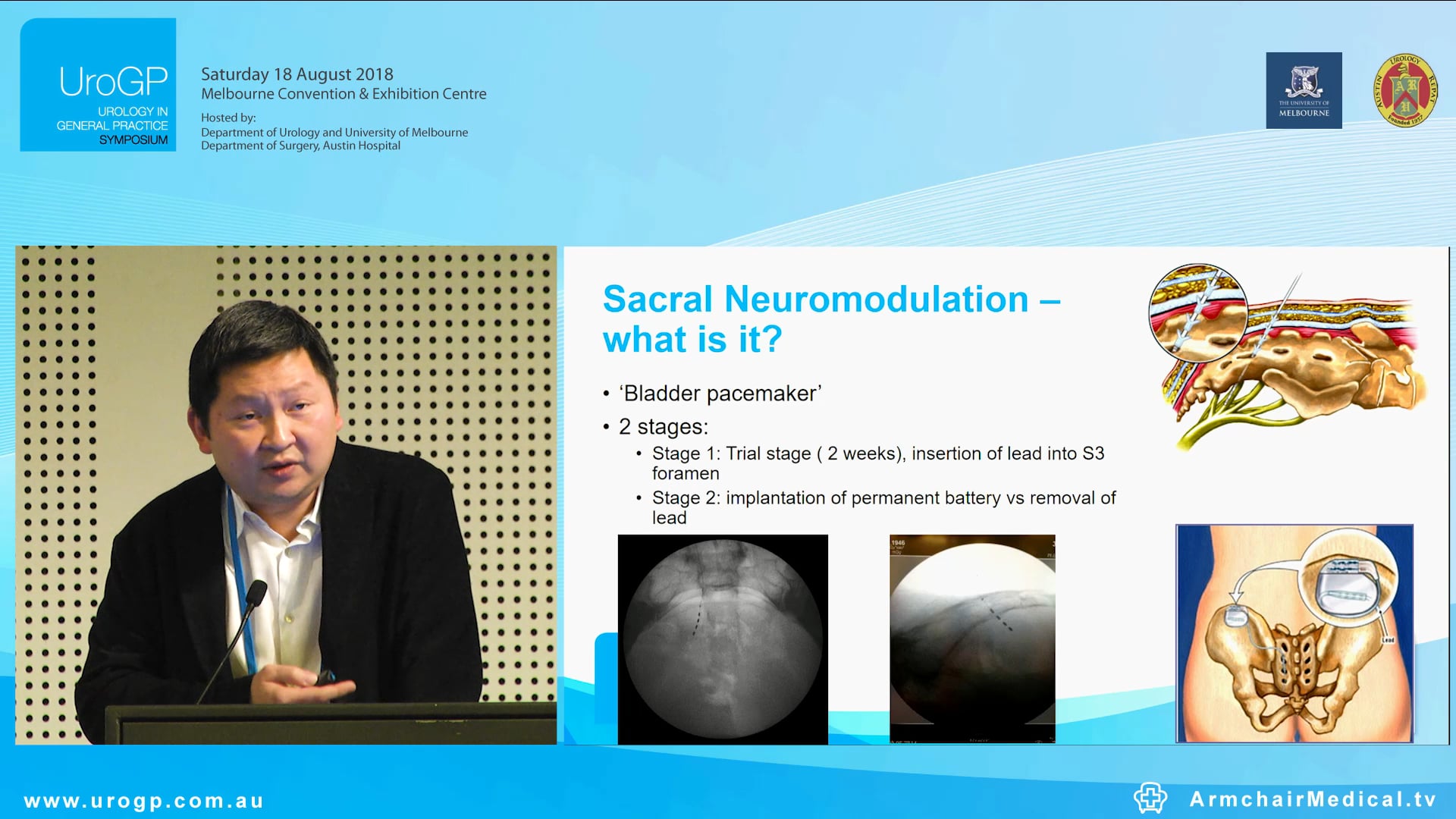 Sacral Neuromodulation for incontinence, Dr Johan Gani