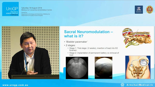 Sacral Neuromodulation for incontinen...