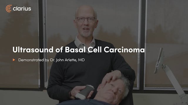 Ultrasound of Basal Cell Carcinoma