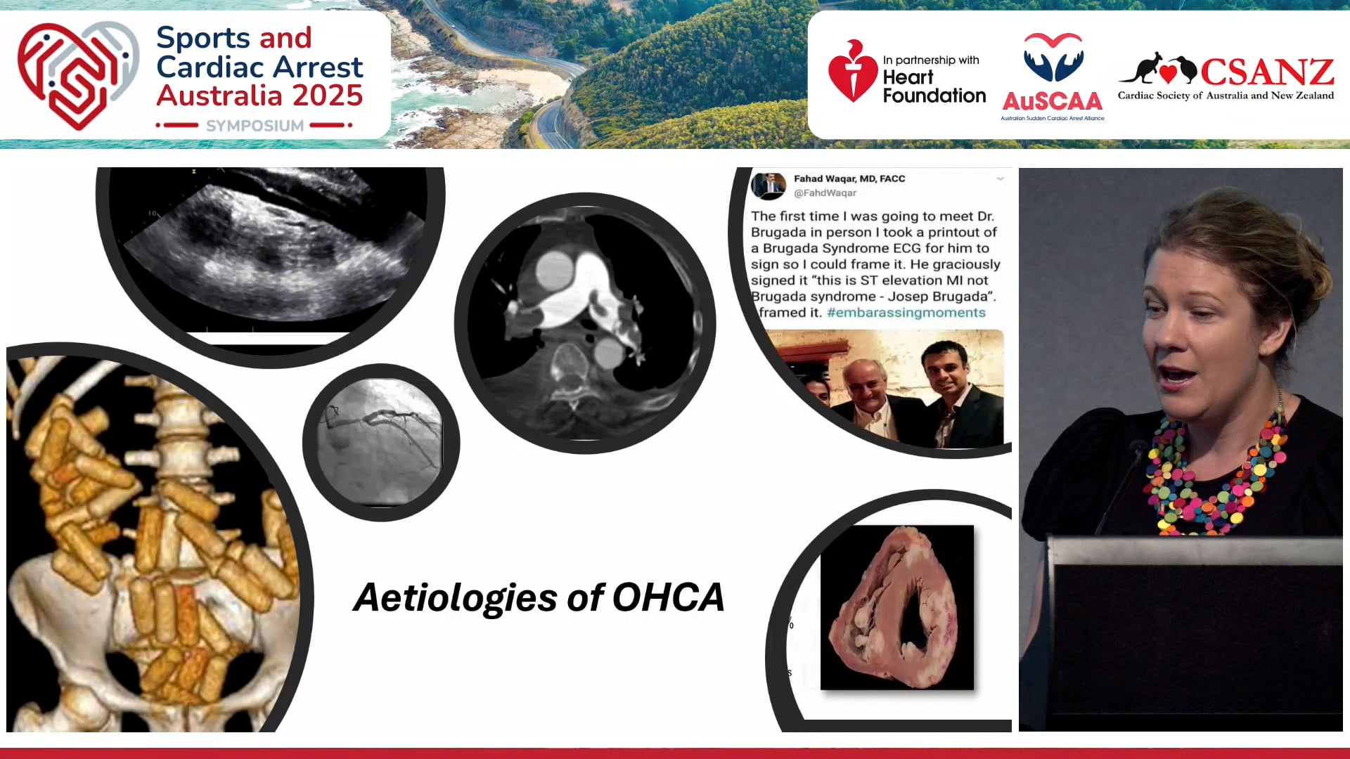 Why do people arrest SCD aetiologies and circumstances Dr Elizabeth Paratz