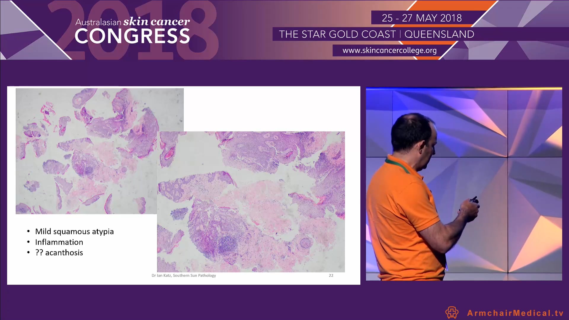 Choosing the most appropriate skin cancer pathology specimen Dr Ian Katz