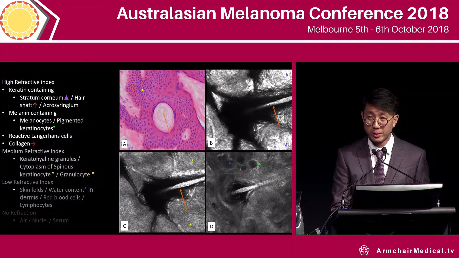A course on the role of confocal microscopy in melanoma diagnosis and management Course Leaders Pascale Guitera, Caterina Longo