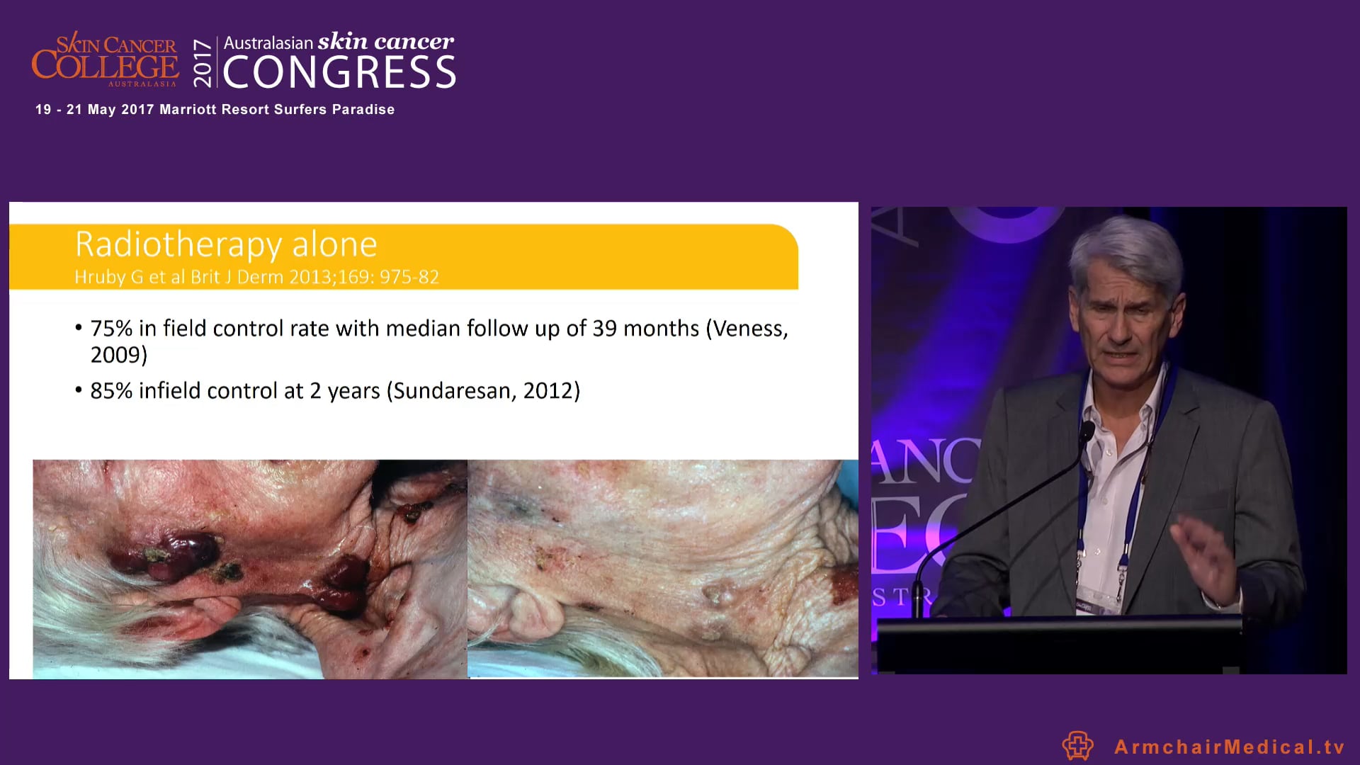 Merkel cell carcinoma of skin A rare skin malignancy Prof Michael Poulsen