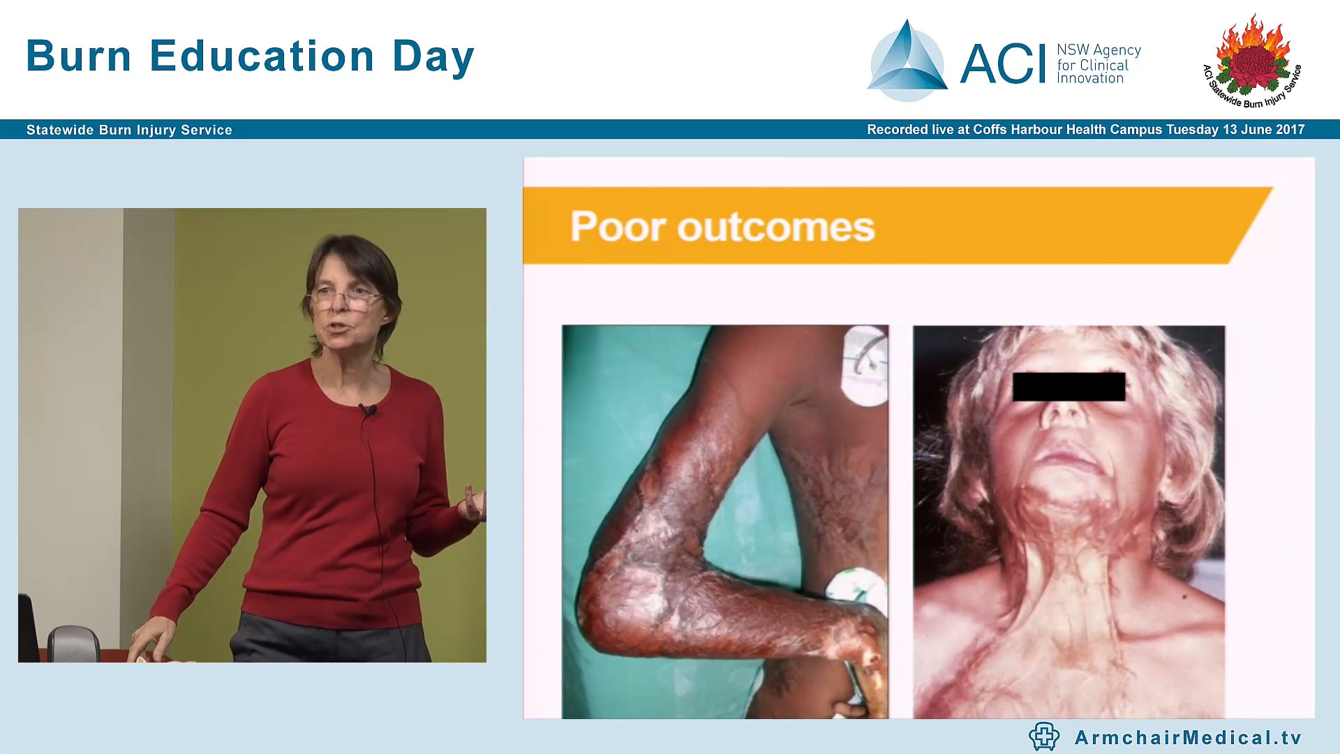 Multidisciplinary Team, Physical Scarring, Functional Interventions, Psycho-social, Nutrition, Communication & Swallowing Anne Darton, Network Manager SBIS Burn Physiotherapist