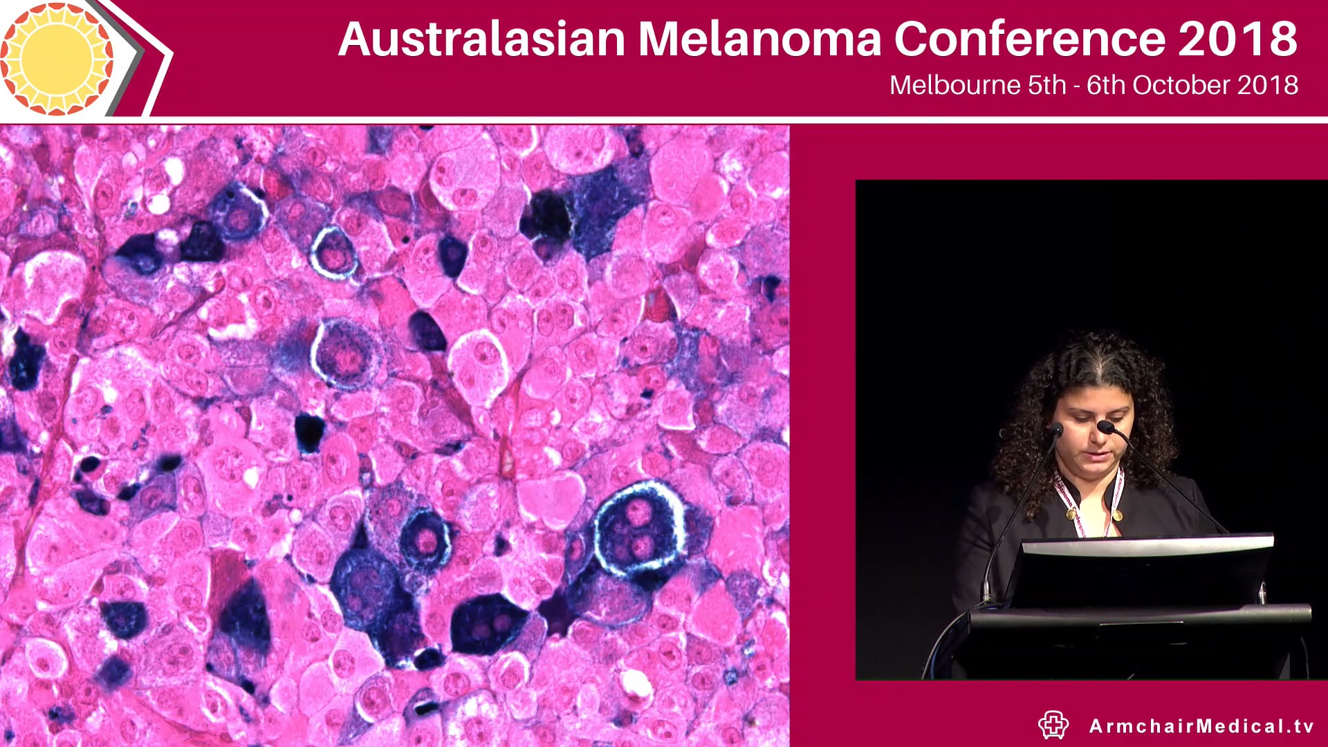 Melanin pigment and melanoma heterogeneity Gamze K Abali
