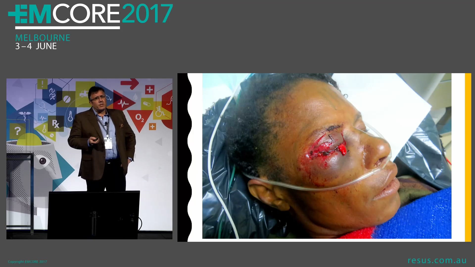 Ocular Trauma Dr Will Davies Emergency Physician