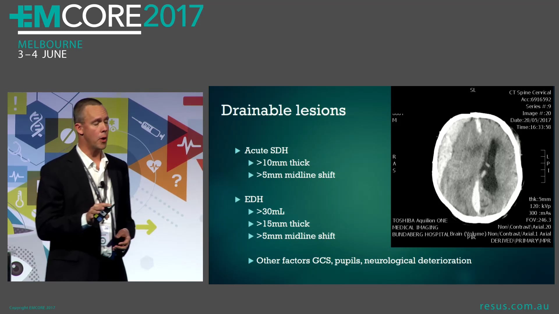 Headache Subdural-Extradural Now What Dr Adam Michael Emergency Physician​