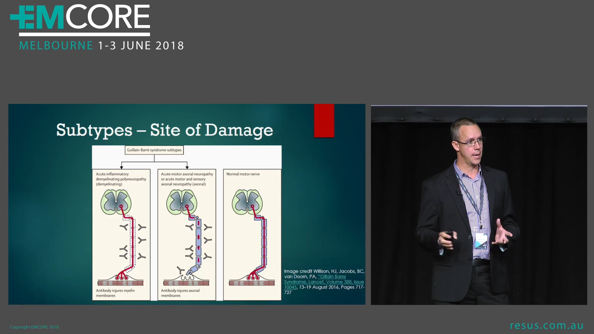 Guillain Barre The Many Presentations Dr Adam Michaels