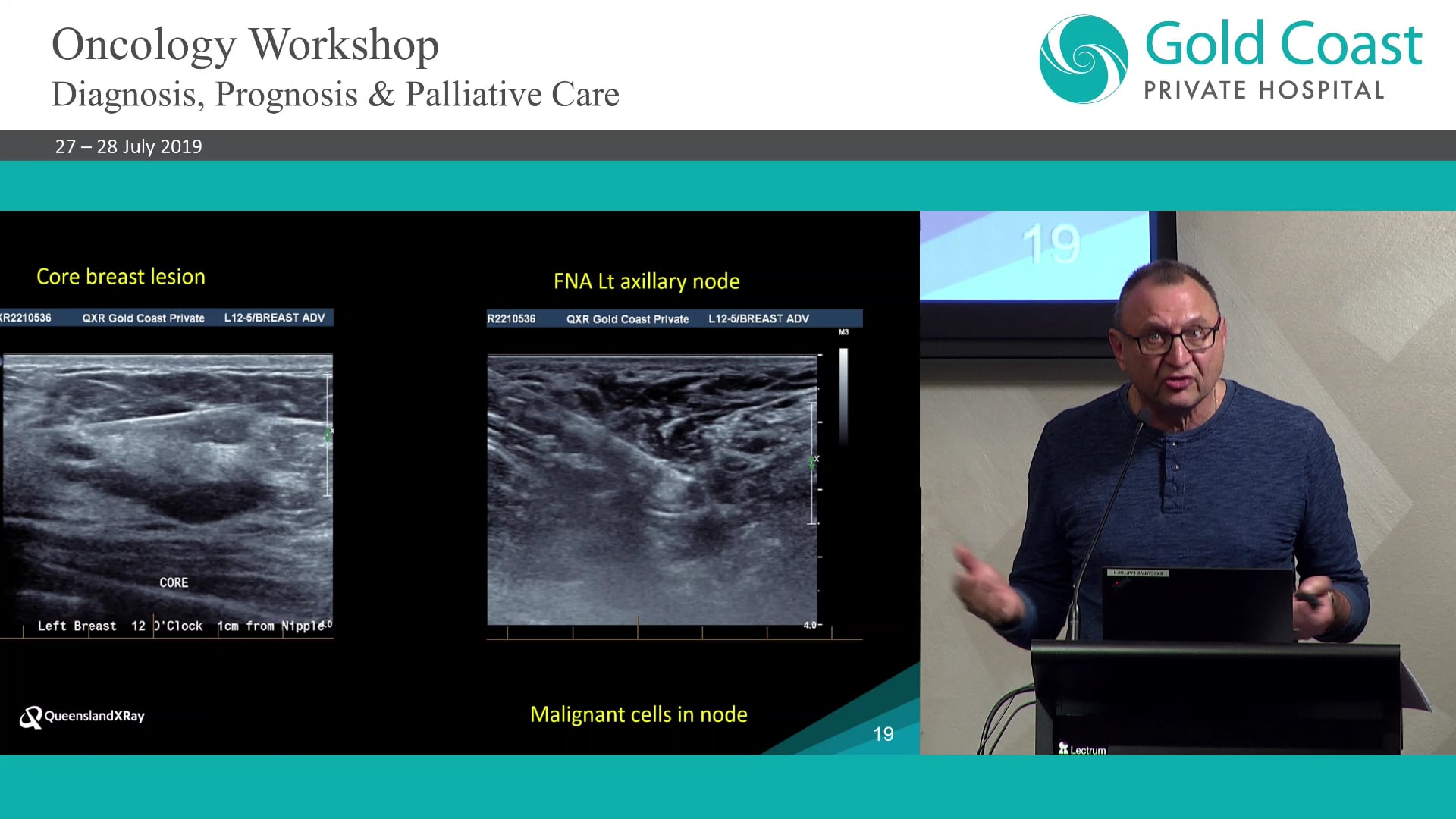 Imaging of Breast Lumps – dispelling the myths and misconception Dr Bruce Leibowitz Radiologist