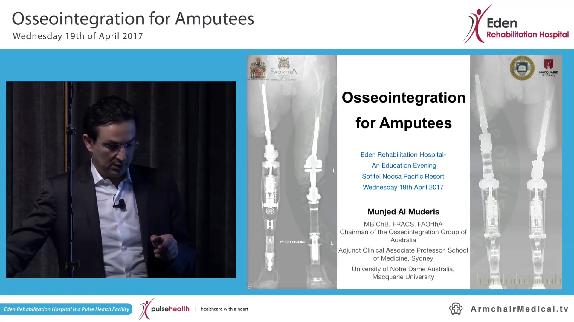 Osseointegration for Amputees Associate Professor Munjed Al Muderis