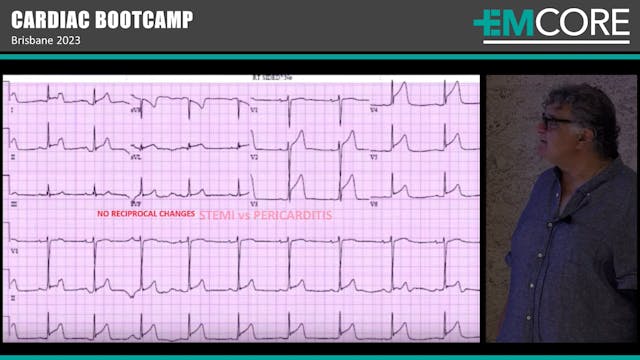 Subtle Ischaemia mimics & STEMI equiv...