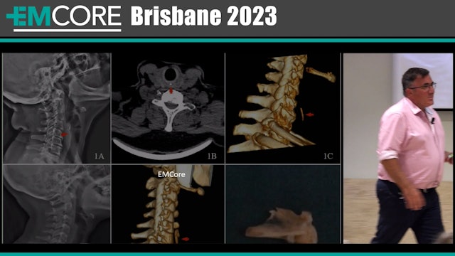 Imaging options for suspected fishbones in the throat Will Davies