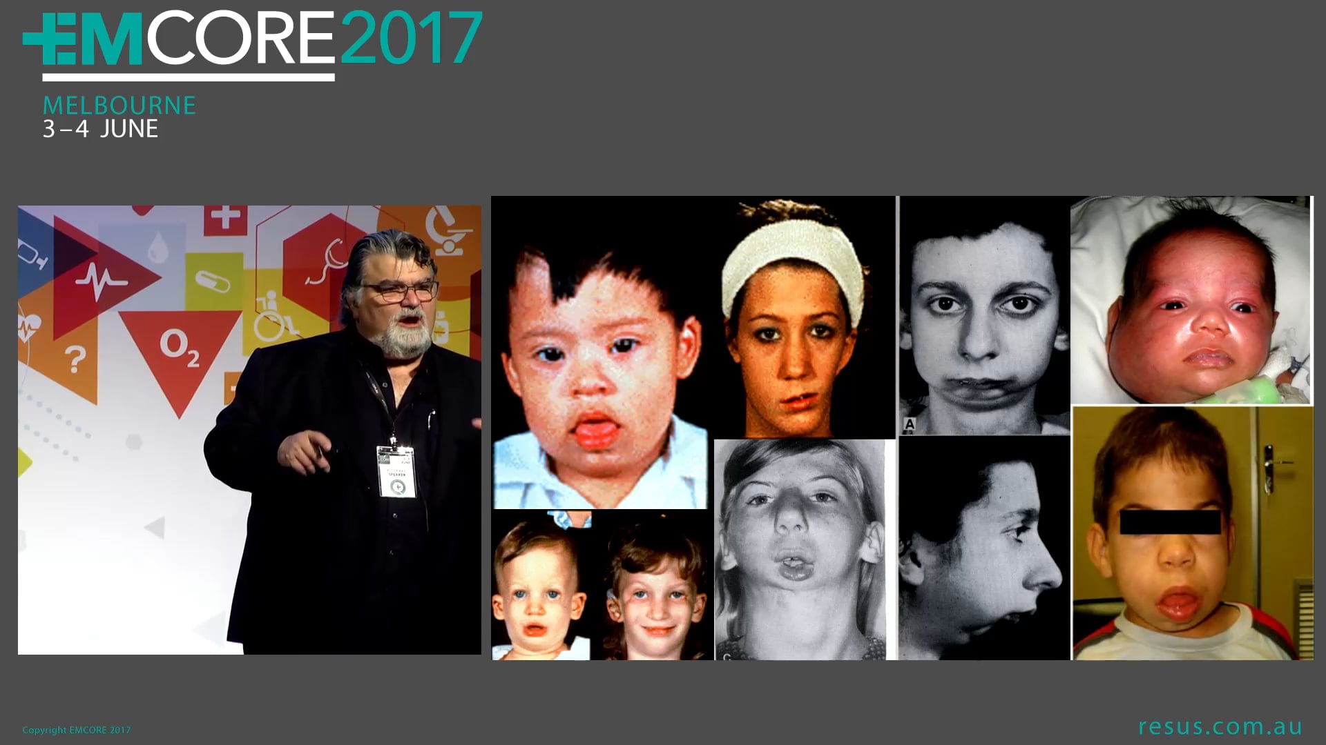 Paediatric Airway Assoc Prof Peter Kas