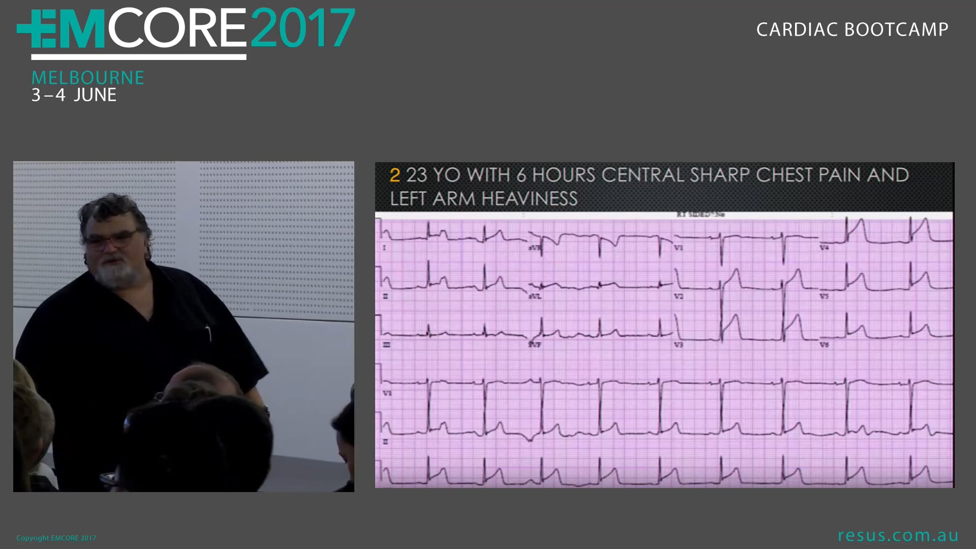 Subtle ischaemic findings of the ECG Assoc Prof Peter Kas
