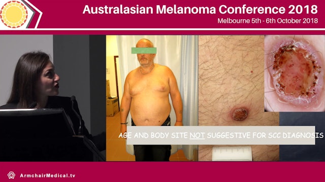 How to distinguish benign imitators of melanoma with dermoscopy Caterina Longo