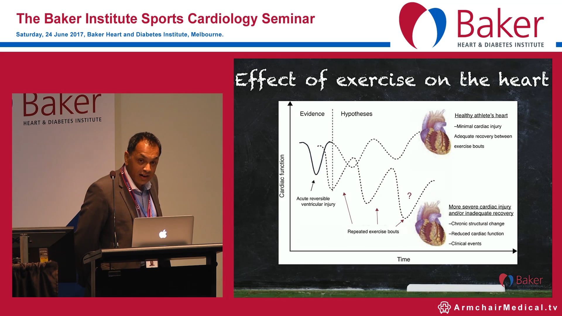 Dilated Cardiomyopathy vs Athlete Heart Dr Dhrubo Rakhit