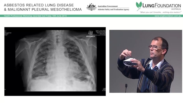 The spectrum of asbestos-related lung and pleural disease Dr Matthew Peters