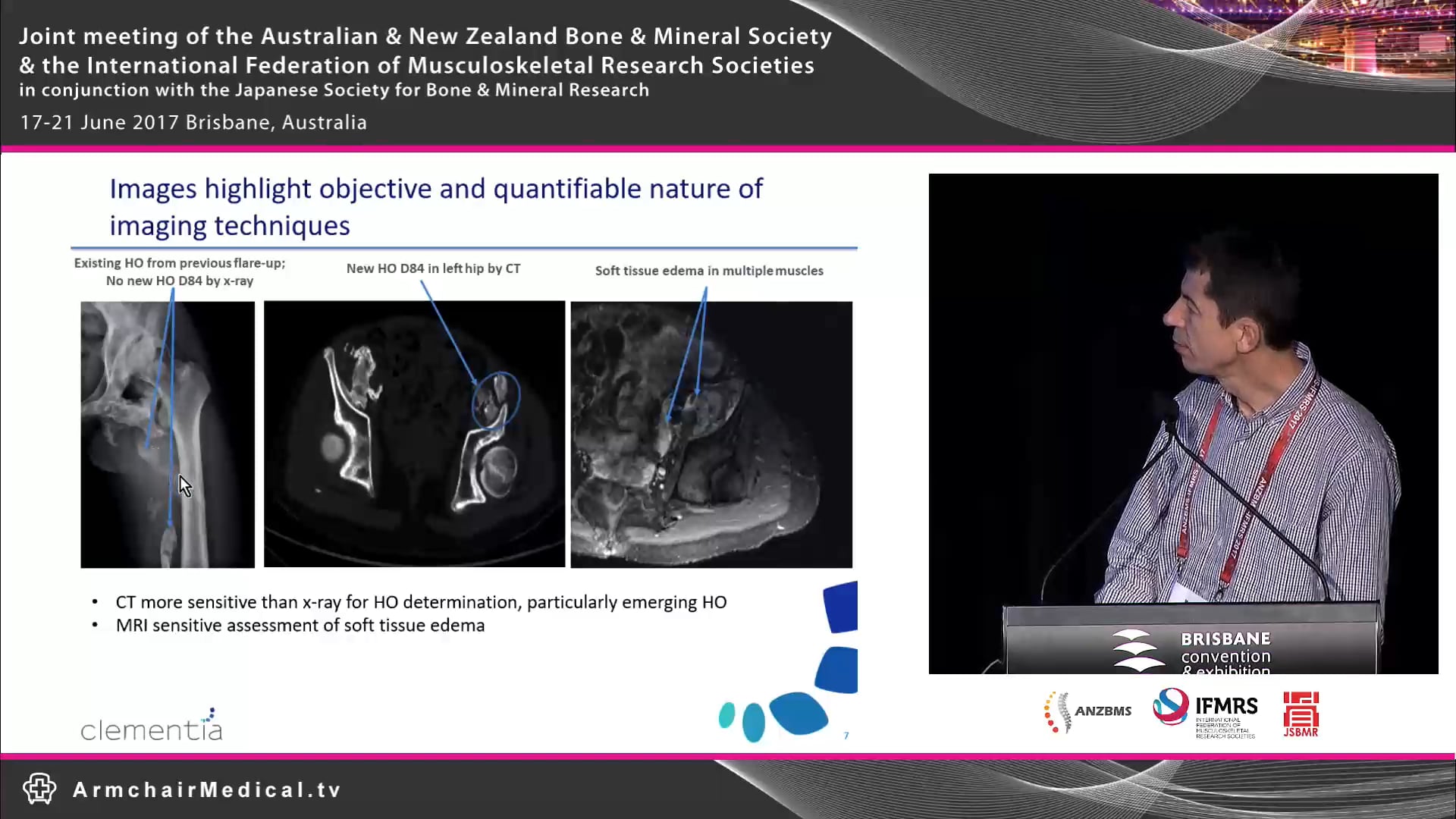 Fibrodysplasia Ossificans Progressiva - From gene discovery to therapy Prof Matt Brown