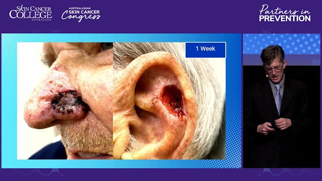 8.1 The nasal ala and chondrocutaneou...