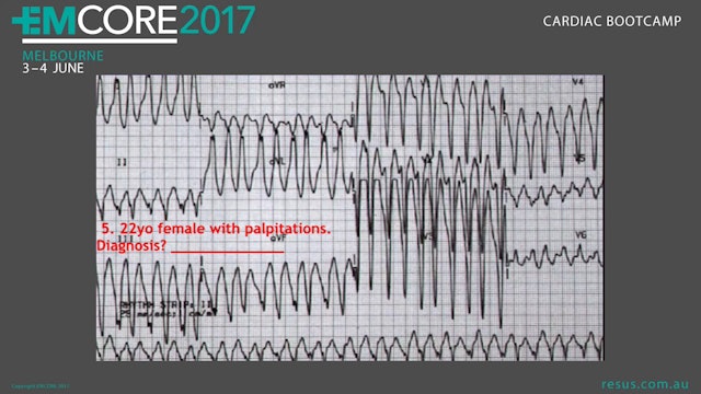 ECG Quiz Cardiac BootCamp 2017