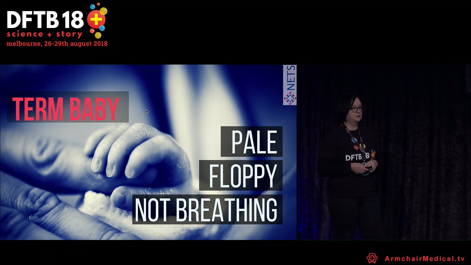 The collapsed cardiac baby Kath Browning Carmo